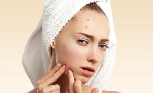 Acne