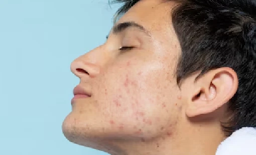 Acne scars