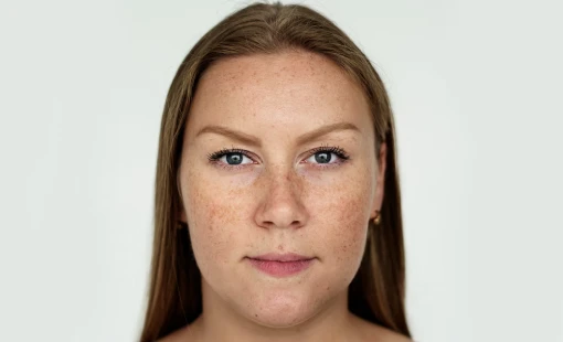 Management of hyperpigmentation