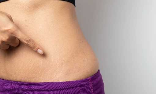 Stretch Marks