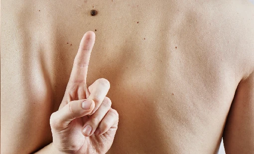 Skin Tags