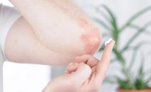 Skin Allergies
