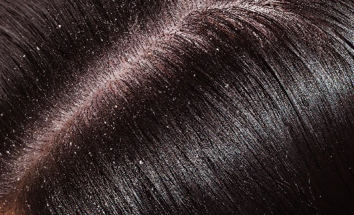 Dandruff