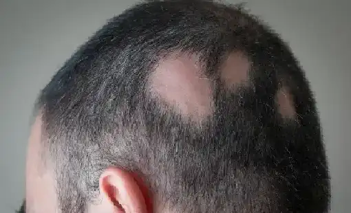 Alopecia Areata