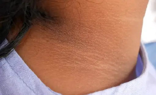 Acanthosis Nigricans