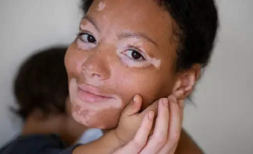 Vitiligo Surgery