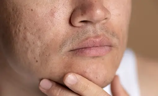 Acne Scars