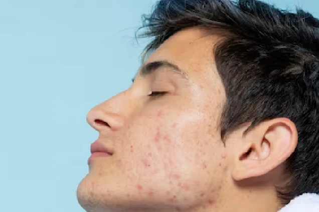 Acne Scar