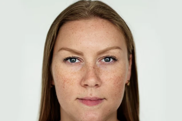Management of hyperpigmentation