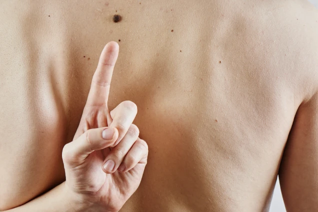 Skin Tags