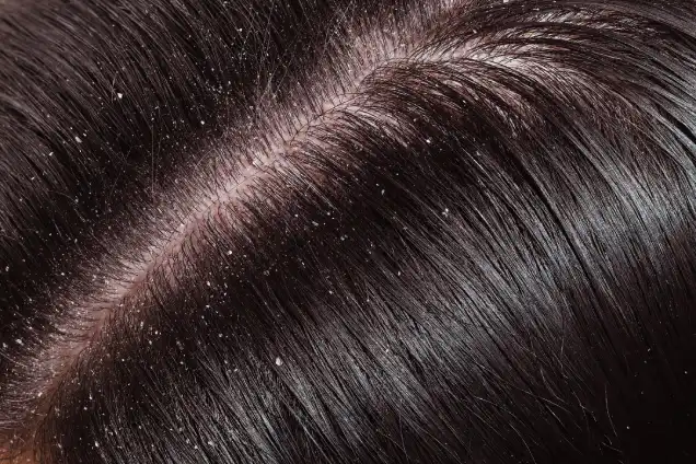 Dandruff