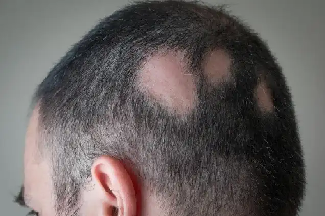 Alopecia Areata