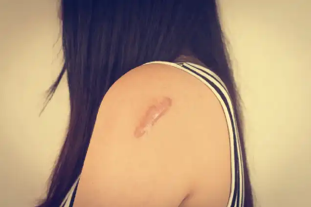 Keloids
