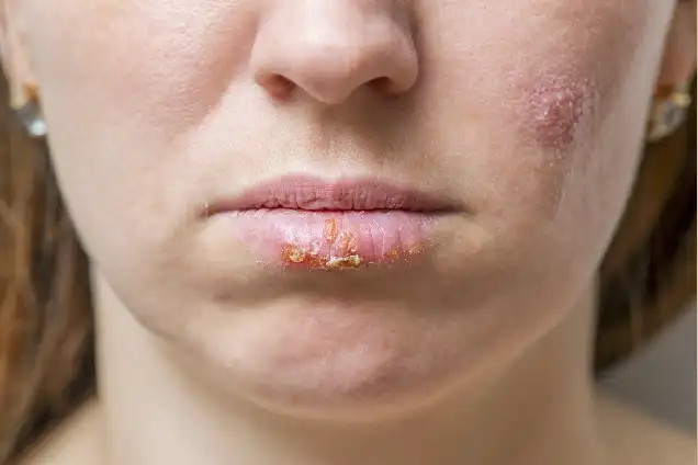 Herpes Infections