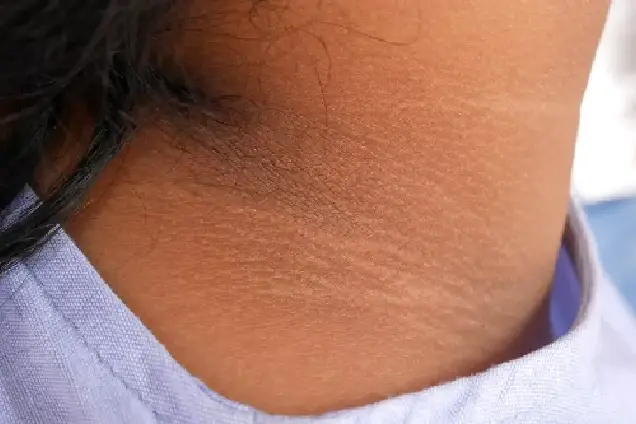 Acanthosis Nigricans