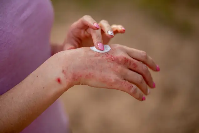 Eczema