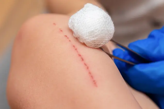 Scar Revision