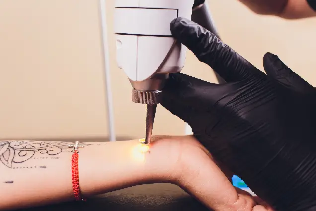 Laser Tattoo Removal