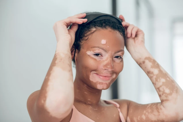 Vitiligo